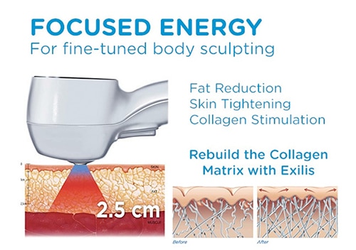 Exilis Ultra Weight Loss Exilis Ultra Weight Loss